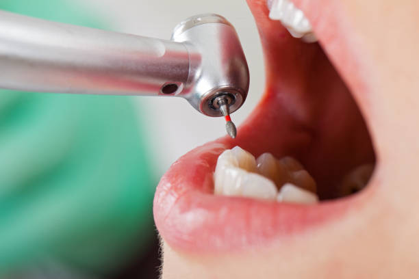 Best Emergency Treatment for Dental Infections or Abscesses in Clinton, UT